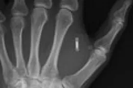 Se implanta por sí mismo un chip RFID y NFC en la mano