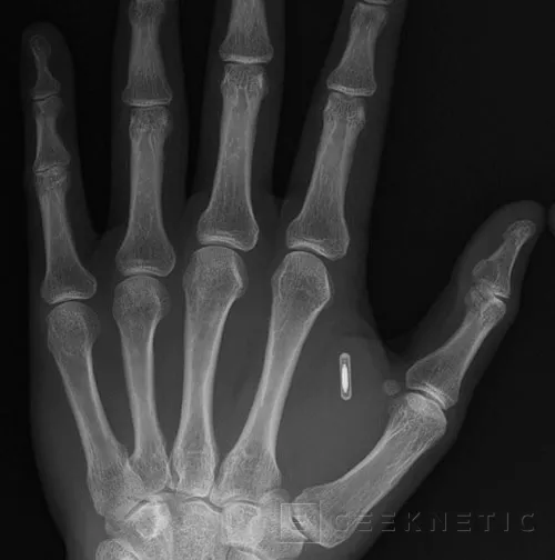 Se implanta por sí mismo un chip RFID y NFC en la mano, Imagen 1